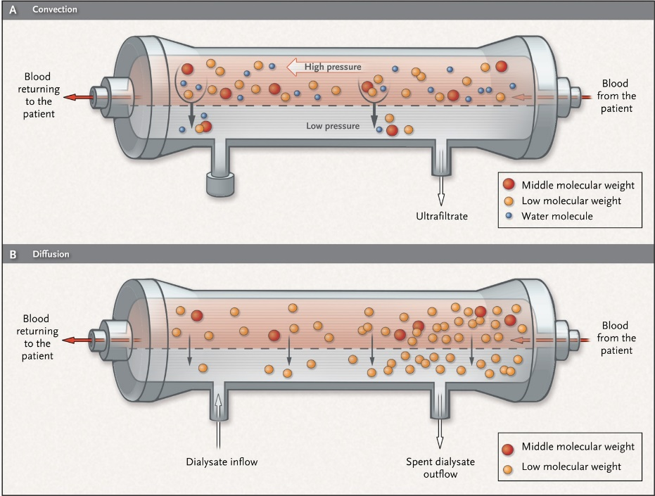 hemodialysis-vs-Hemofiltration2.png